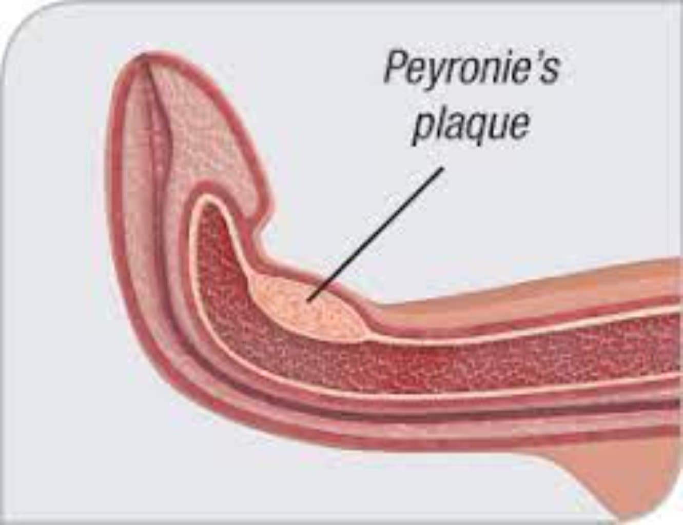 Cinsi orqanın plastik indurasiyası (Peyroni xəstəliyi)