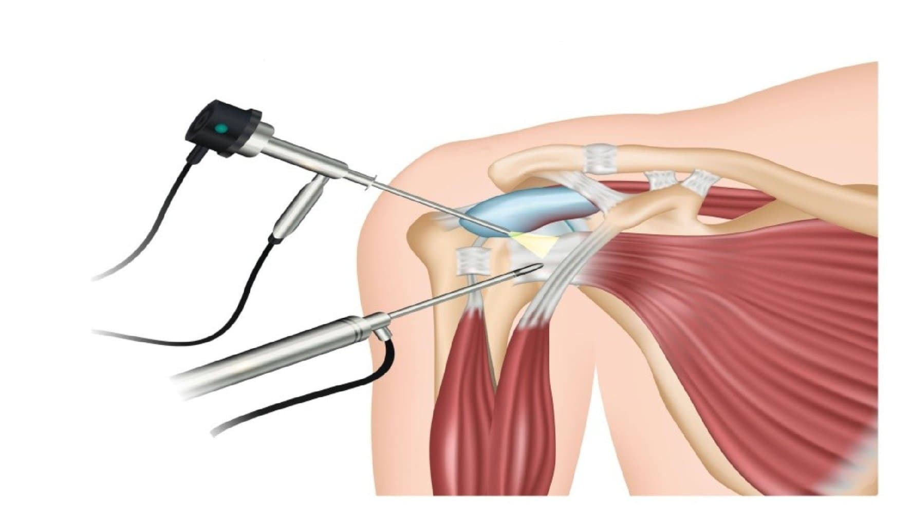 Çiyin çıxıqlarının və təkrarlanan çiyin çıxıqlarının müalicəsi