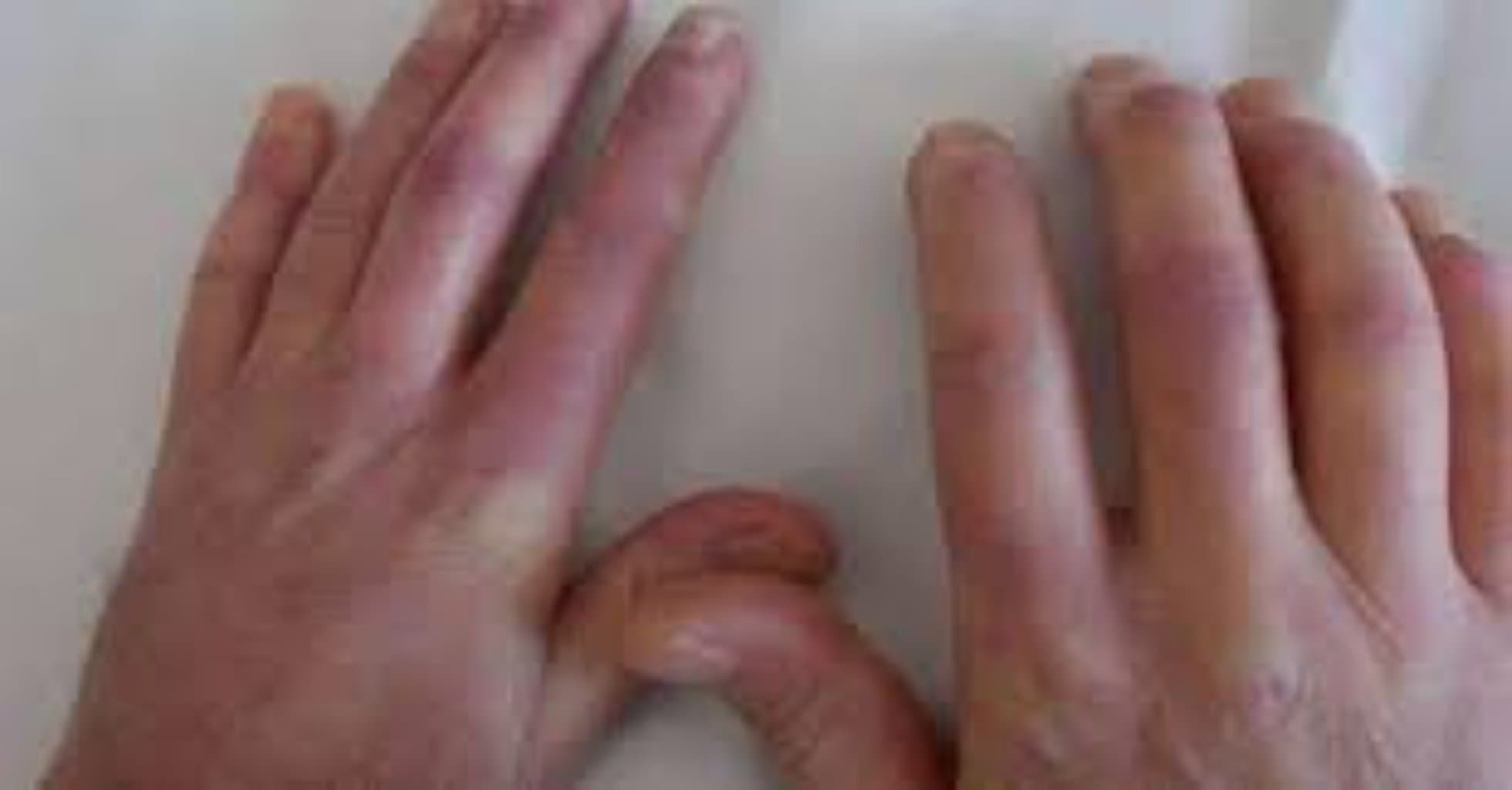 Dermatomiozit/polimiozit