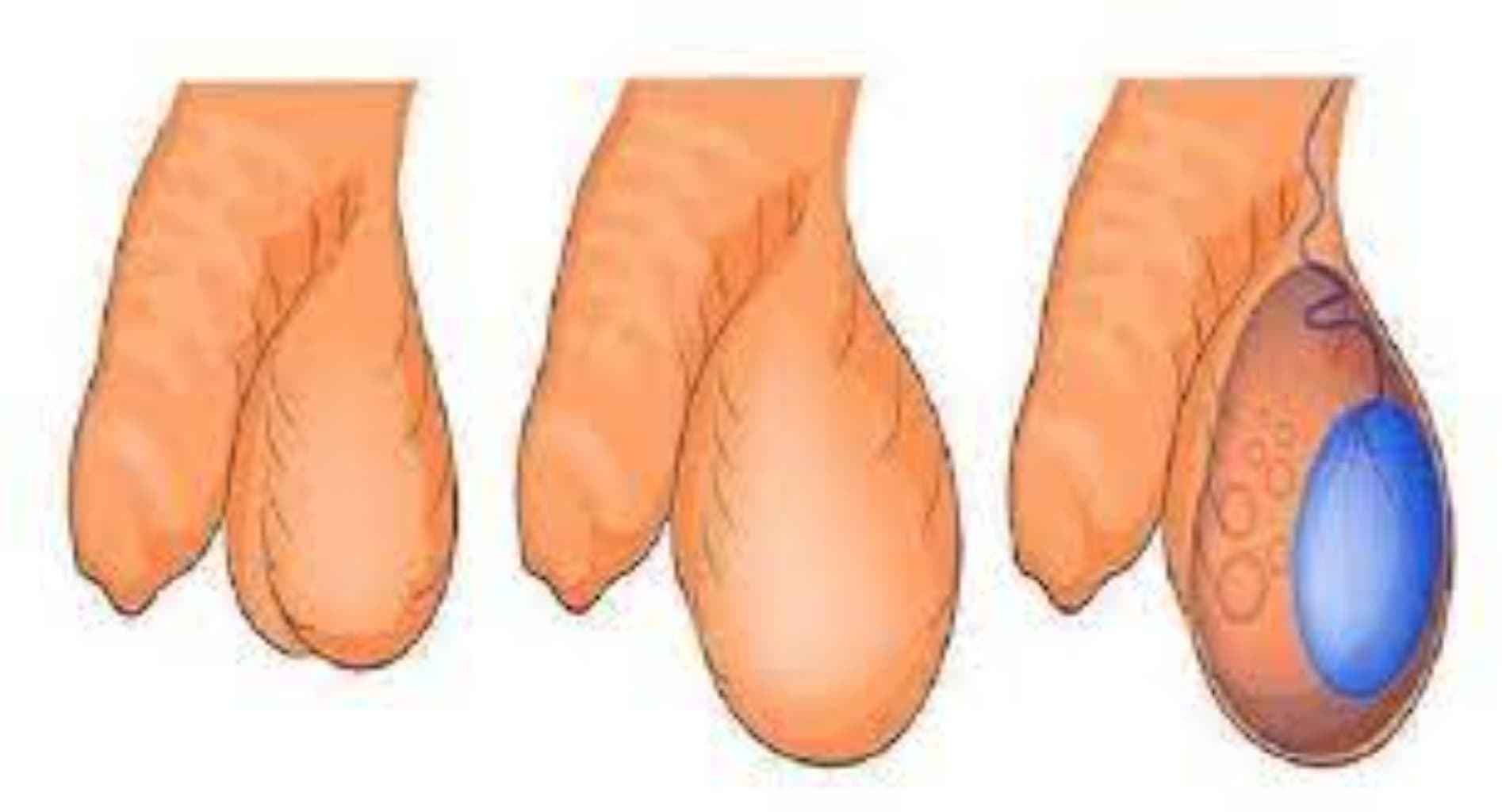 xaya hidropsu hidrosele