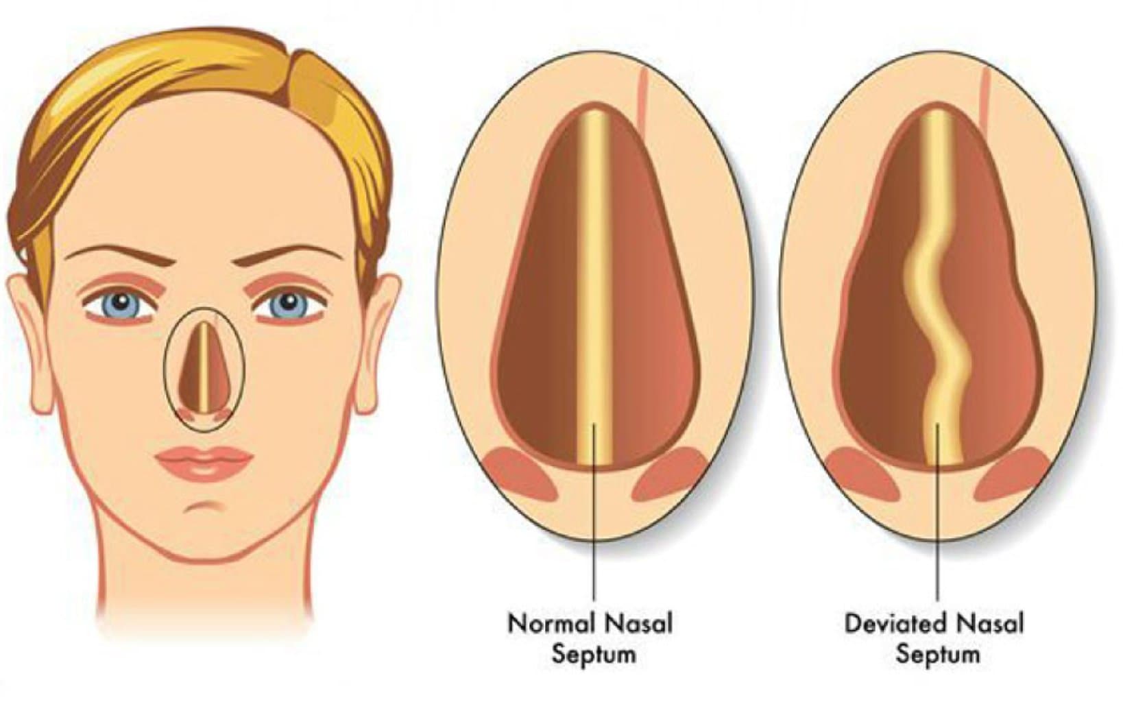 Burun balıqqulaqlarında aparılan əməliyyatlar