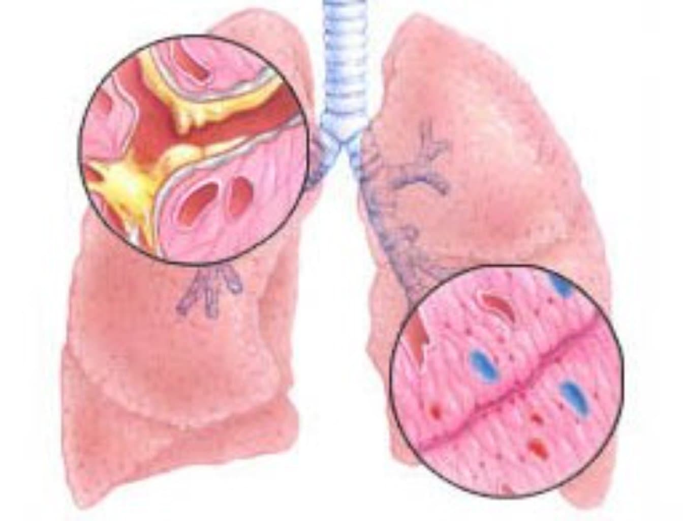 Kəskin və xroniki tubulointerstisyal nefritlər