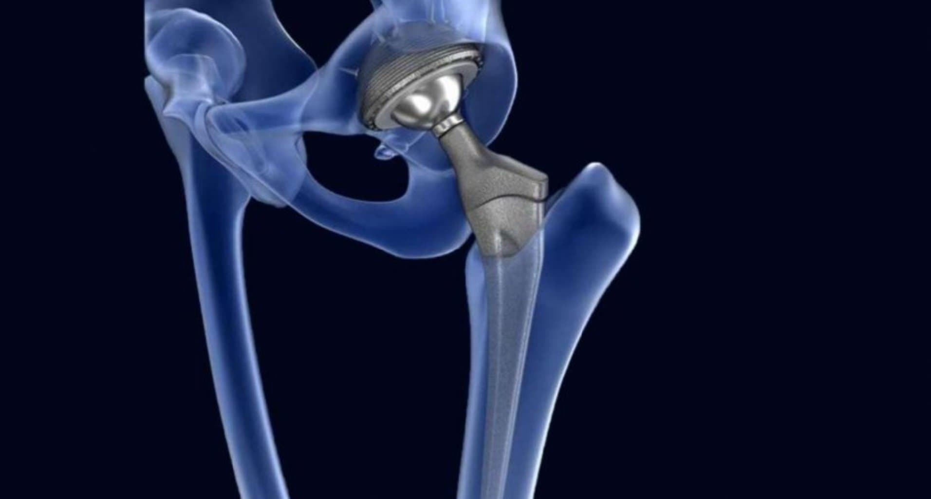 Çiyin Protezi: Çiyin Birgə Problemlərini Düzəltmək üçün Cərrahi Həll