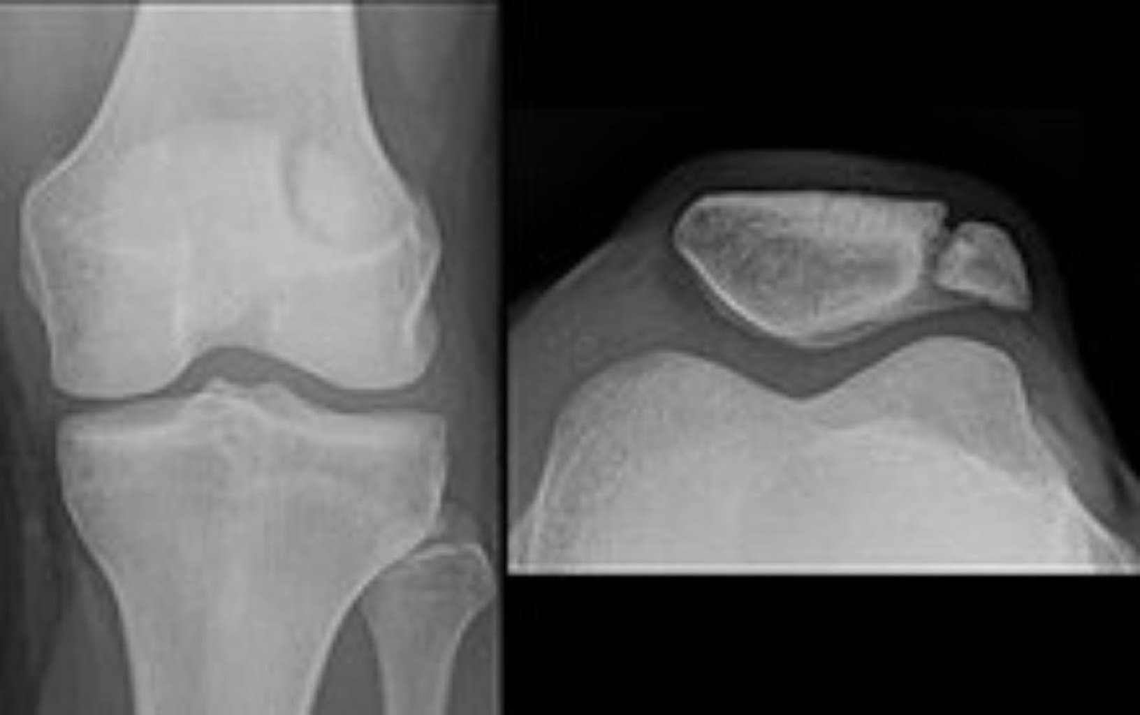 Diz qapağının sınıqları