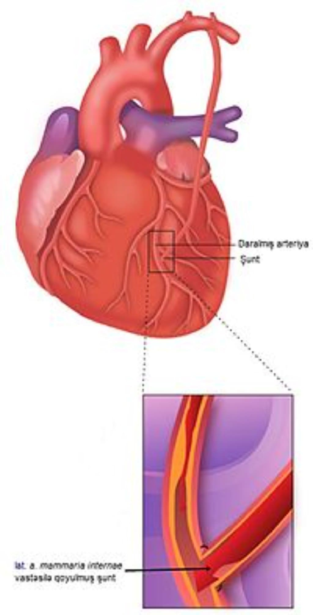 Koronar Arter Bypass Grafting (CABG) Əməliyyatı: Ürək Damarlarının Bypass Edilməsi
