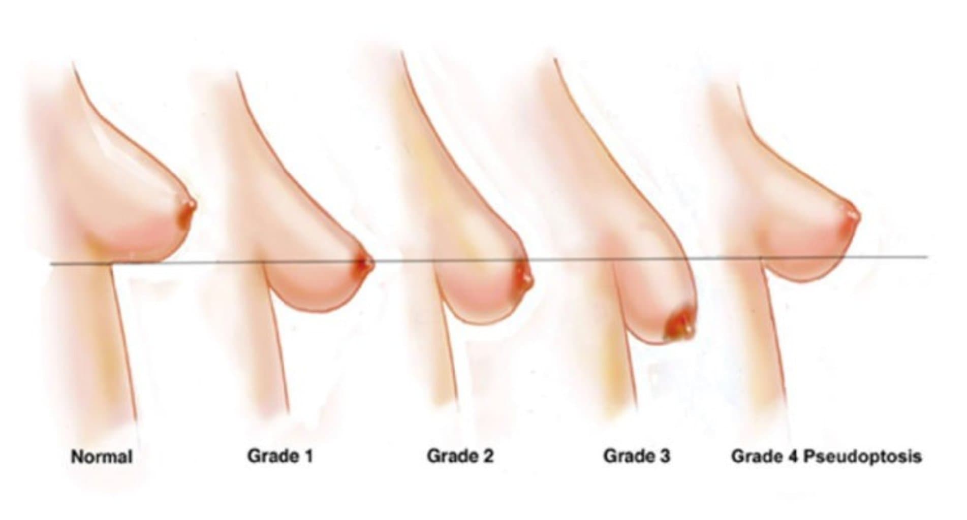 Sinə Dikləşdirmə Əməliyyatı nə deməkdir?