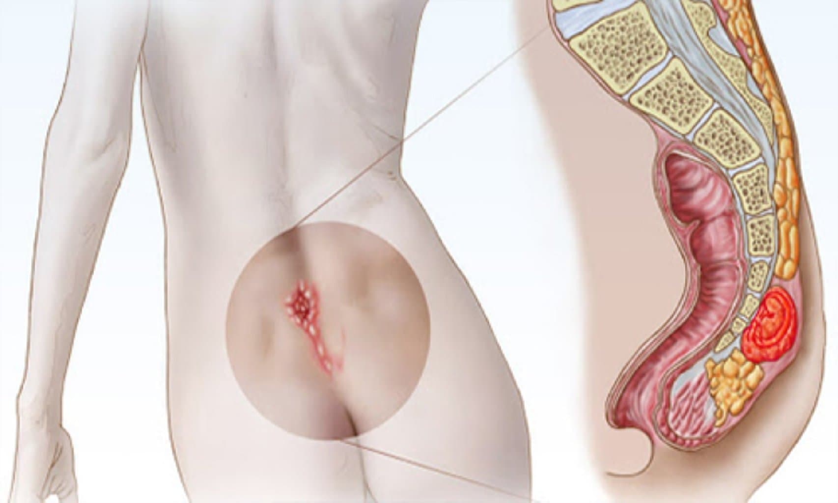 Pilonidal Sinus (qıl dönməsi)