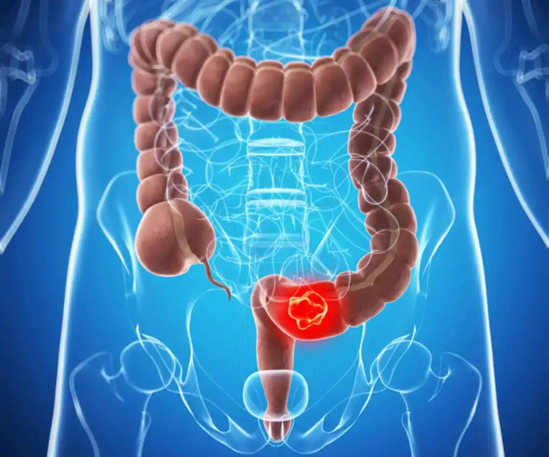 Yoğun bağırsaq xəstəlikləri