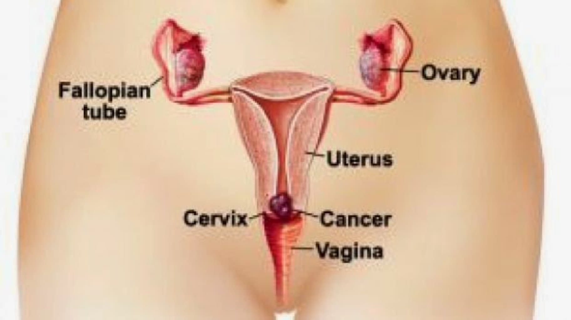Endouretral kondilomalar