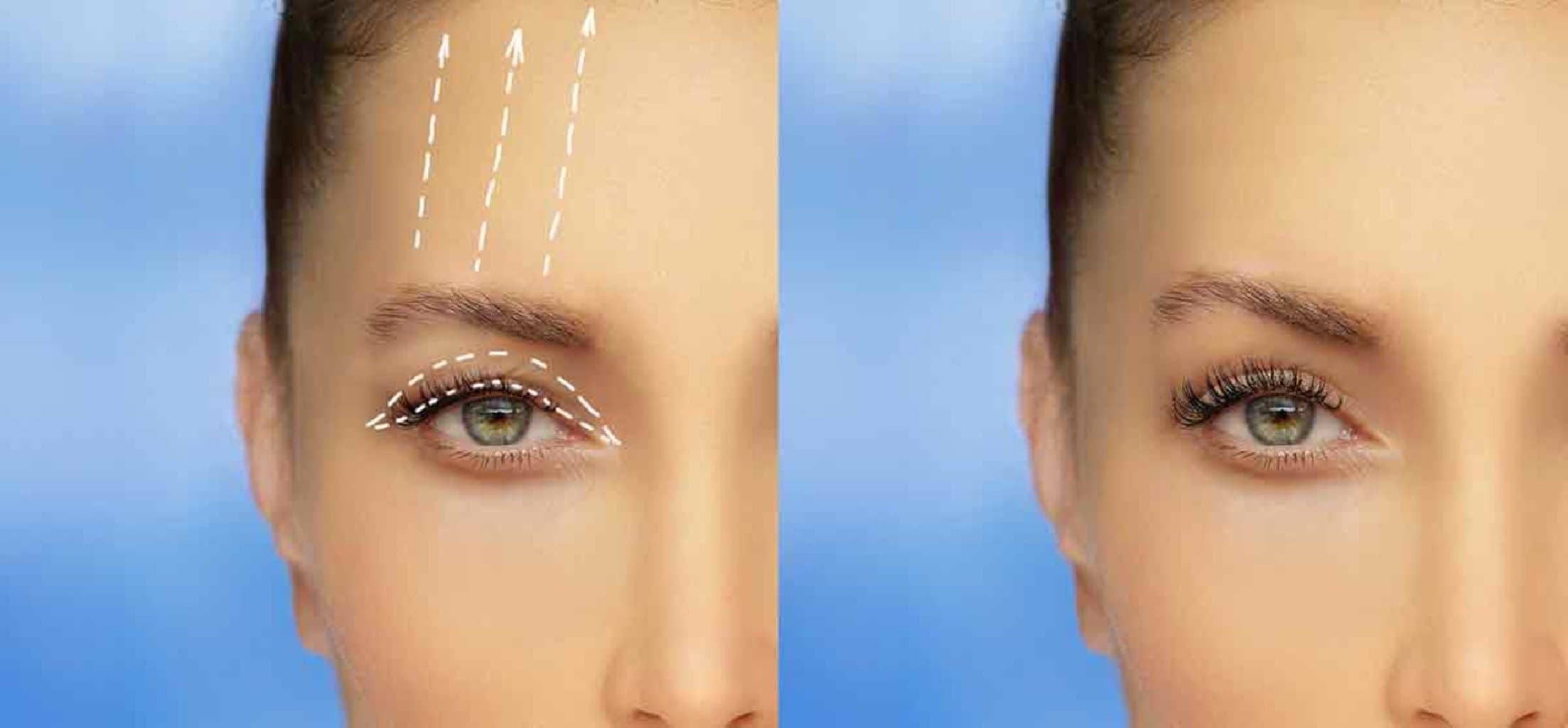 Göz qapaqlarının estetikası haqqında məlumat