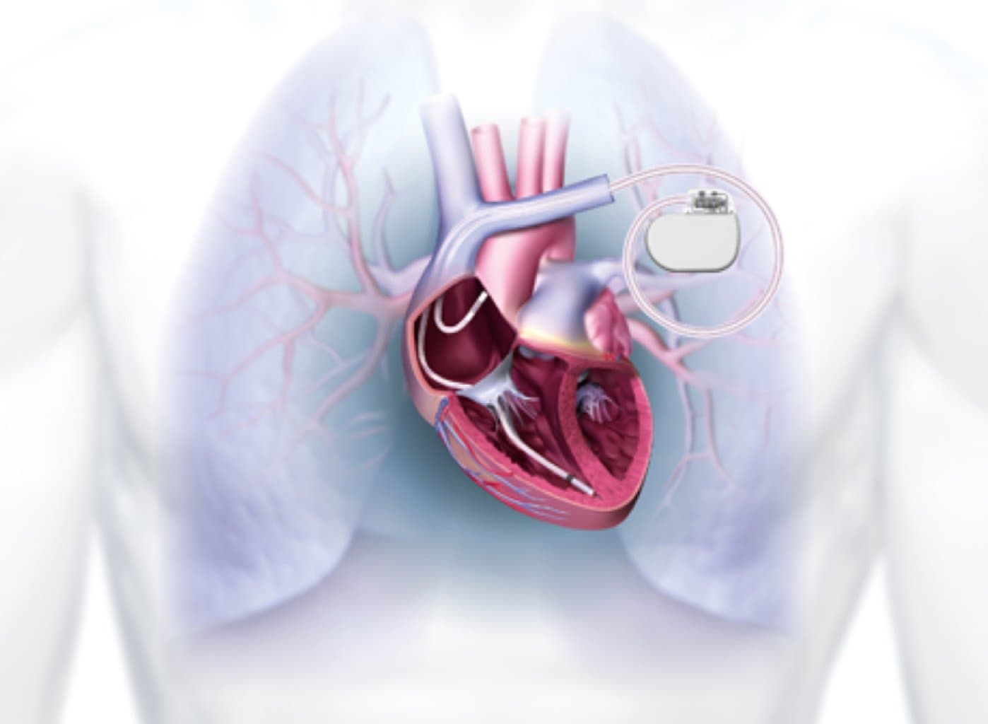 Defibrilasiya İmplantı: Ürək Ritmini Saxlamaq üçün Vacib Cihaz
