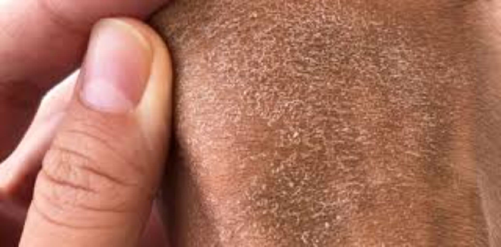 Büllöz dəri xəstəlikləri