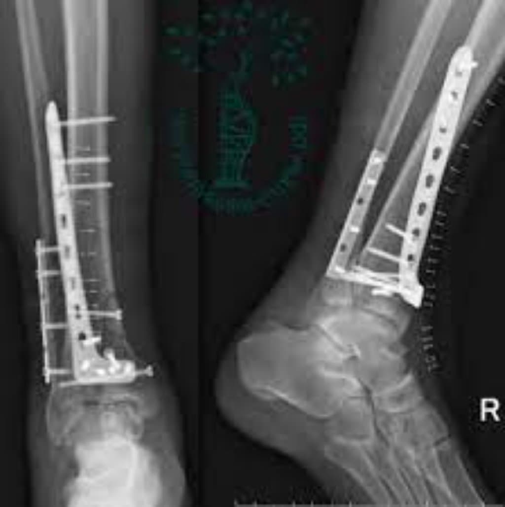 Osteosintezın bütün növləri