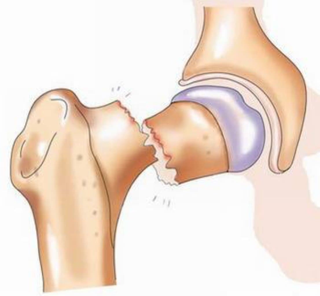 Sümük Sınıqları: Diaqnoz, Müalicə və Sağalma Prosesi