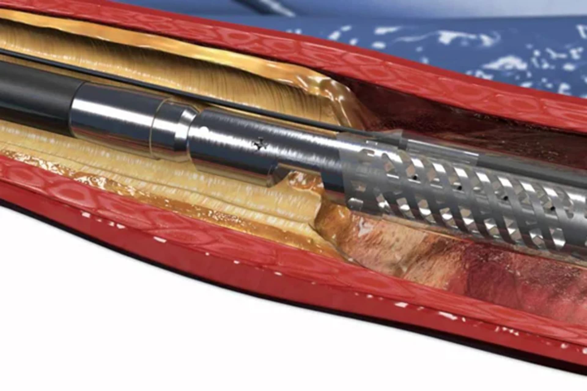 Aterektomiya: Ürək-damar Sağlamlığını Yaxşılaşdırmaq üçün Müalicə Yolu