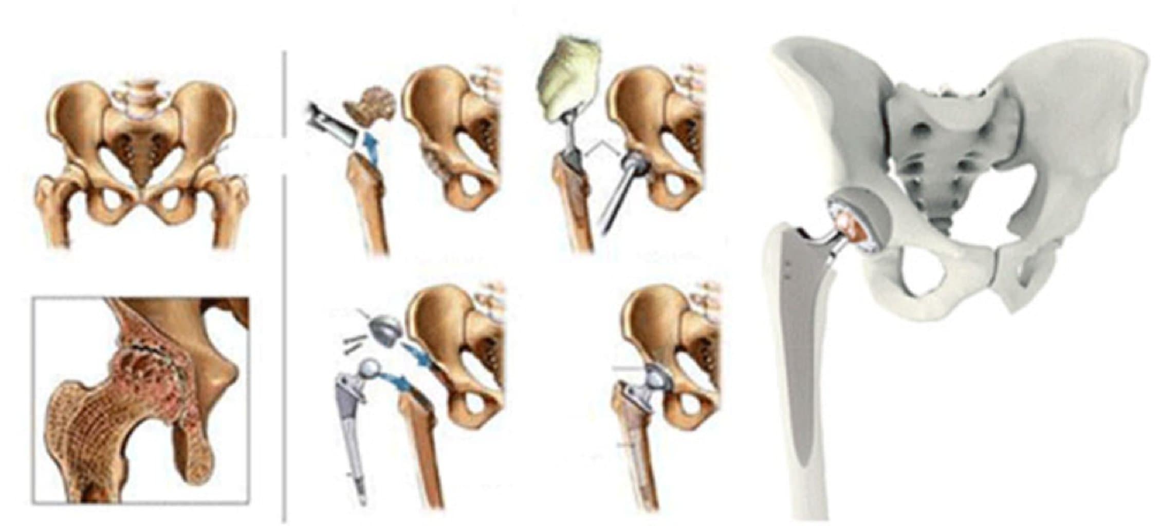 Bud sümüyünün sınıqları