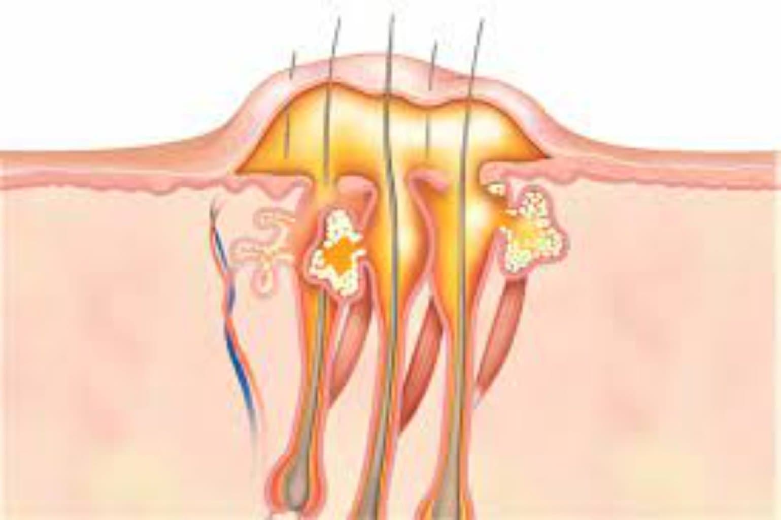Yumsaq toxumalarin absesi