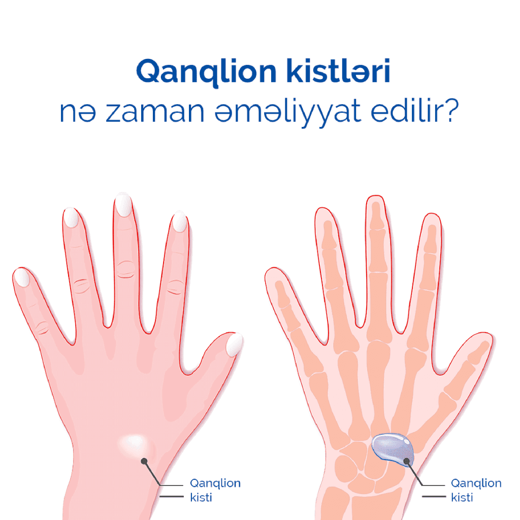 Qanqlion kistləri