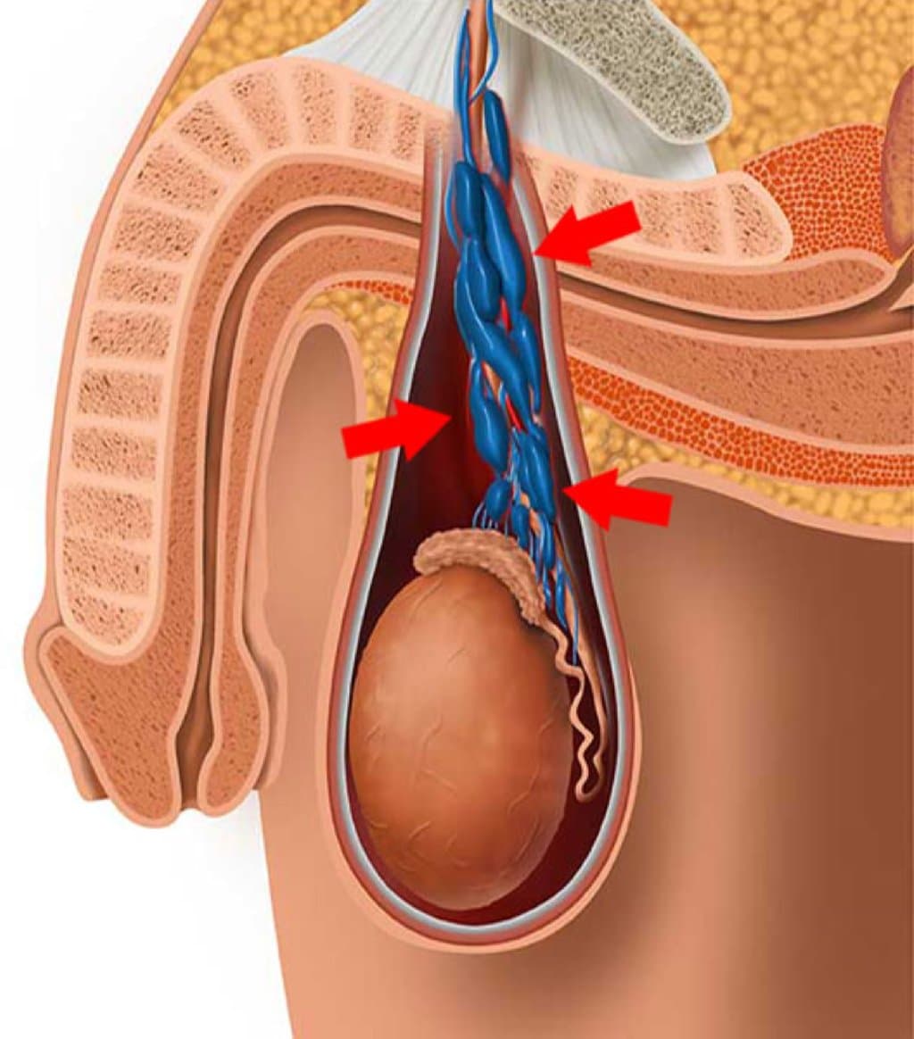 Varikoselin mikrocərrahiyyə yolu ilə müalicəsi