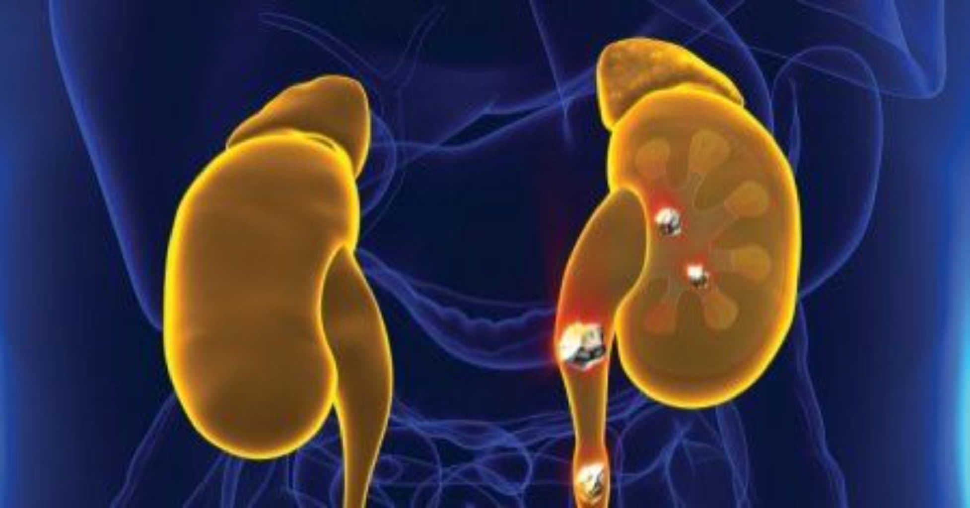 Sidik daşı xəstəliyi