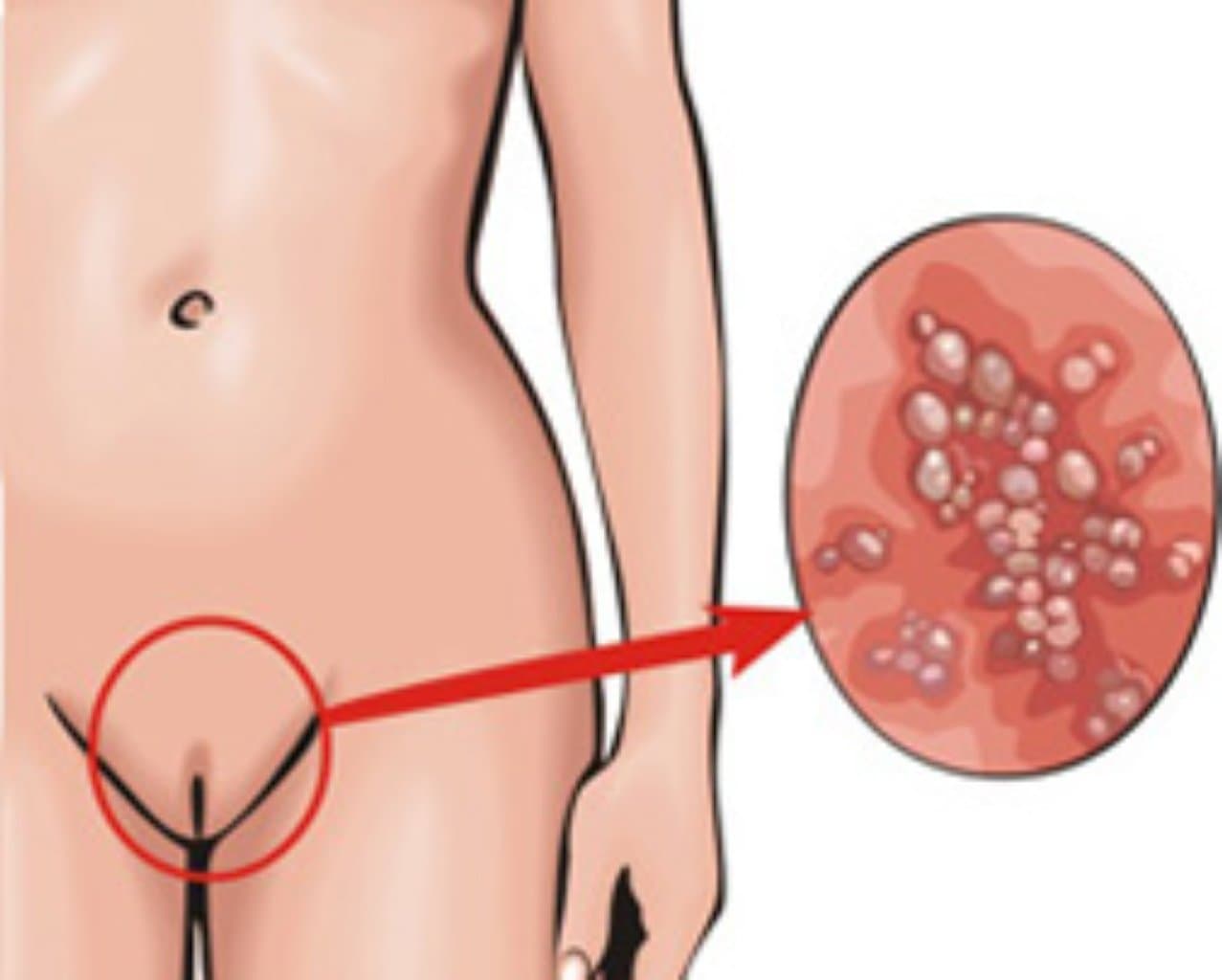 Urogenital papillomavirus infeksiyası (iti uclu kondilomalar)