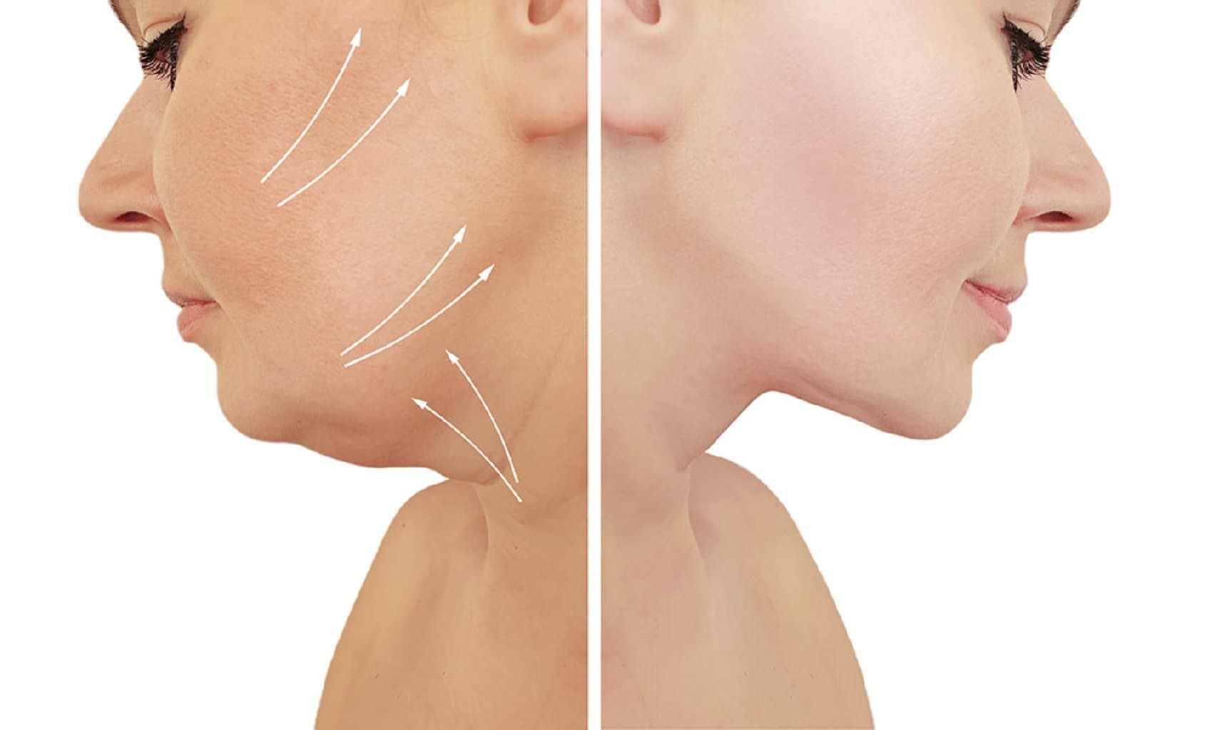 Boyun və Üz Liftinqi