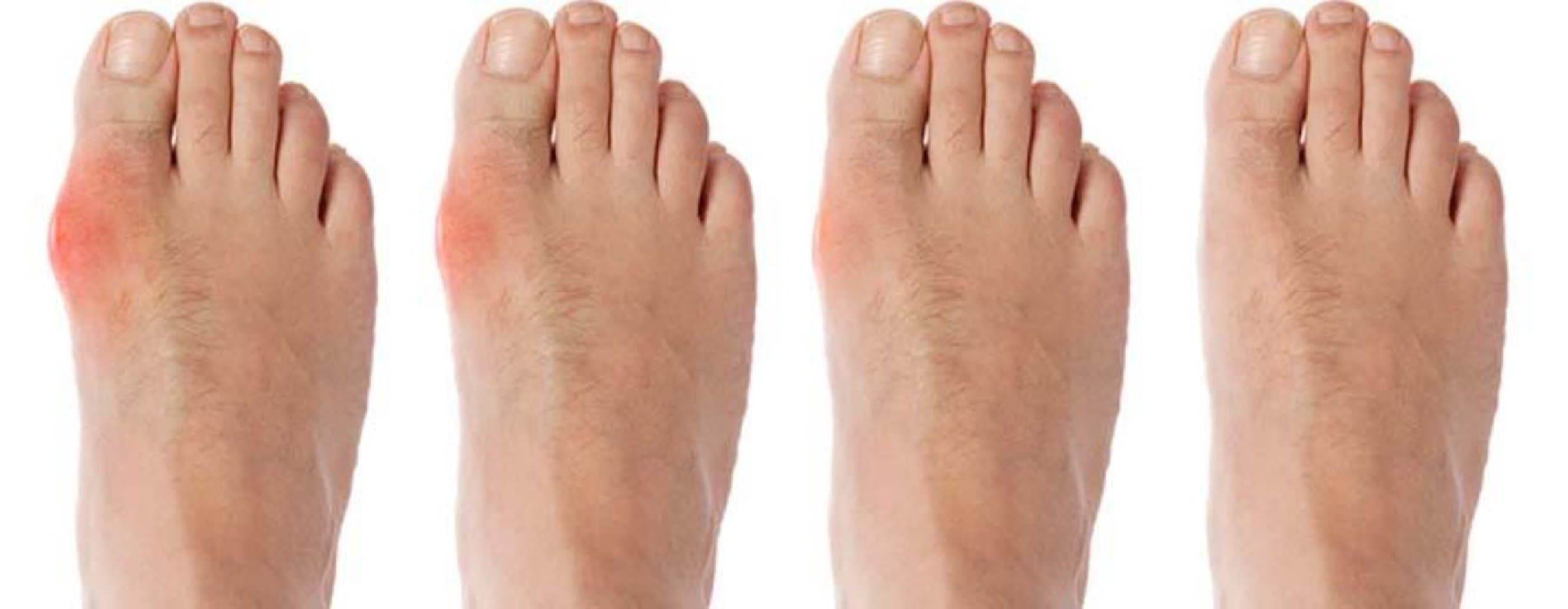 Hallux valgus