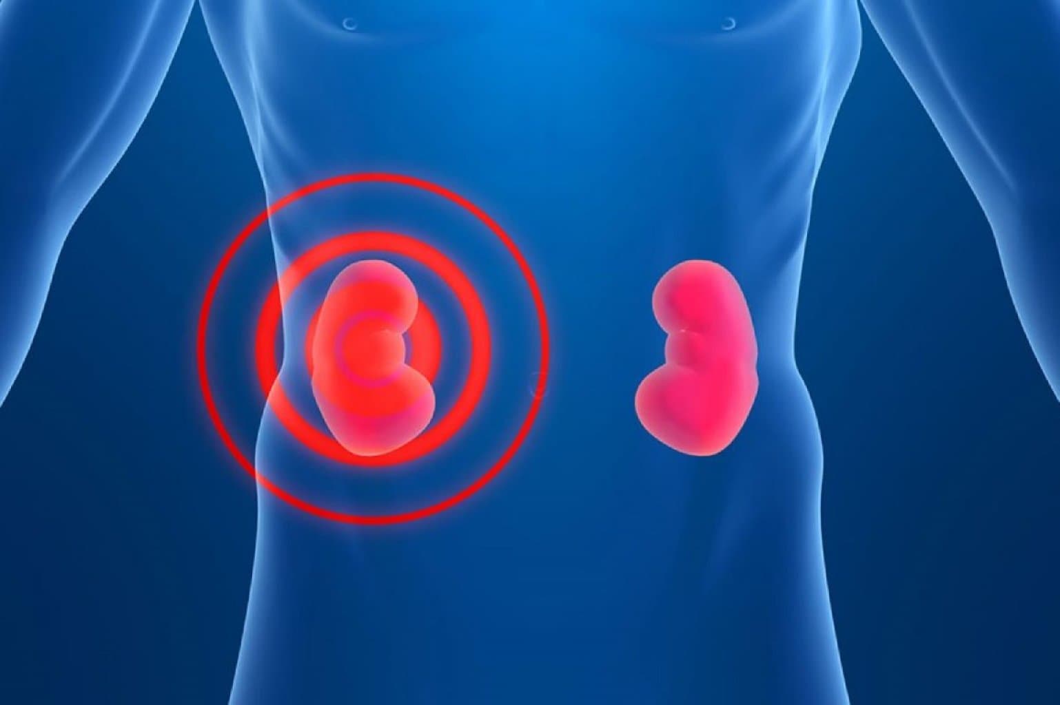 Piyelonefrit (kəskin, xroniki)