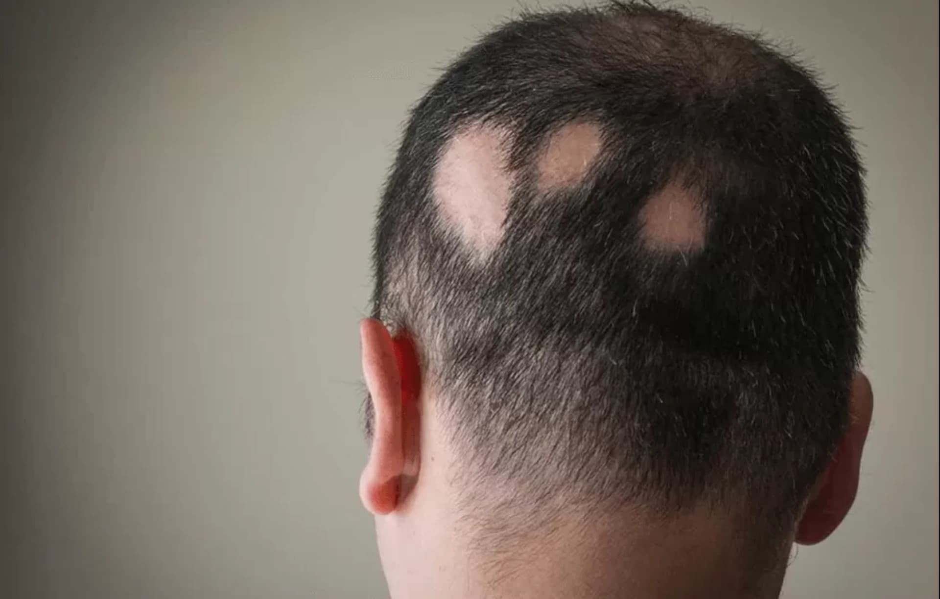 Alopesiyalar (Saç tökülməsi)