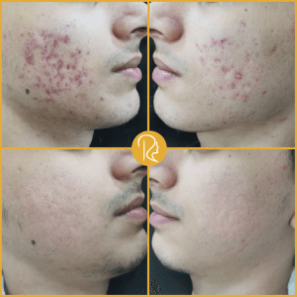 Dermatologiyada Müdaxilədən Əvvəl və Sonra: Hazırlıq və Bərpa Prosedurları