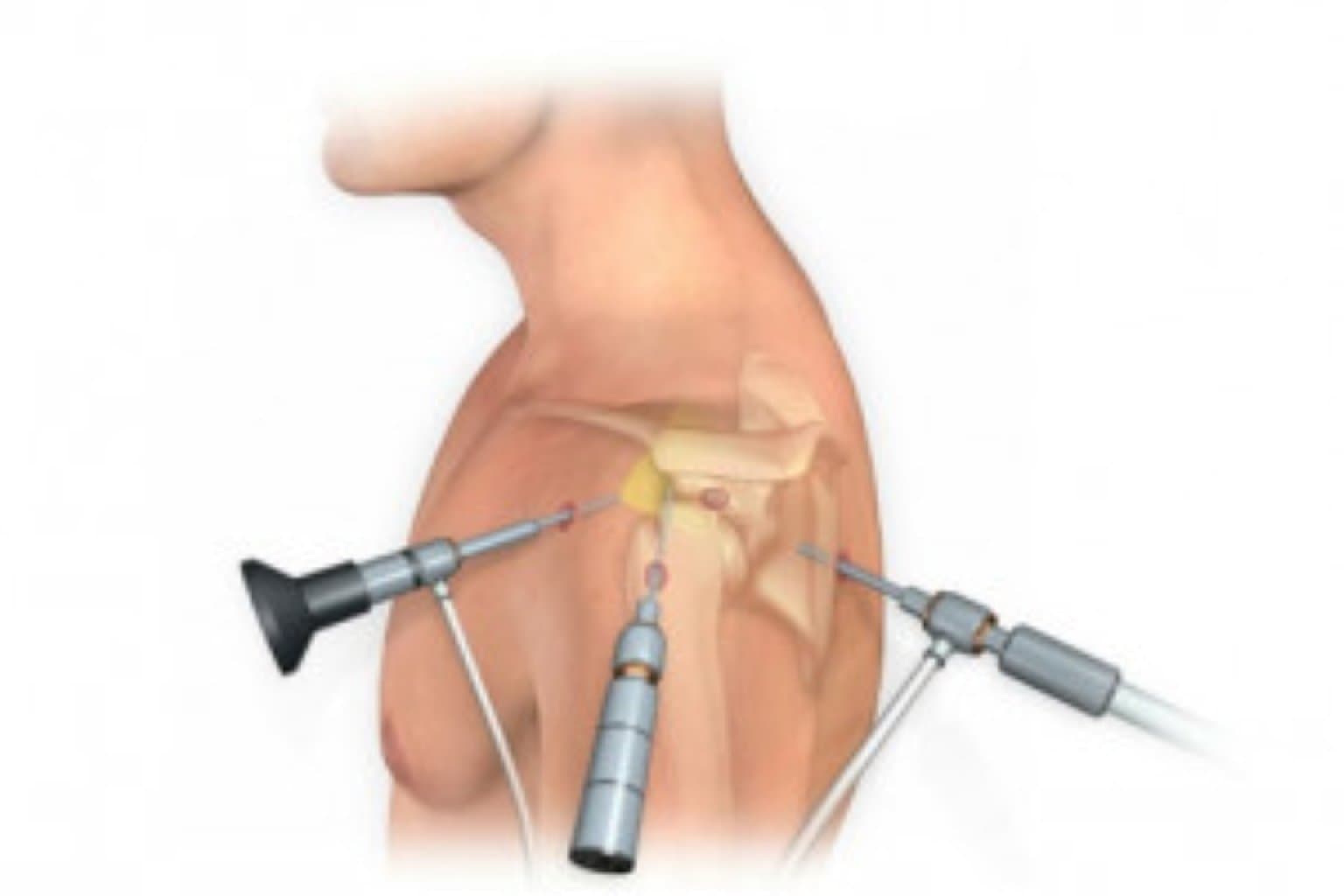 Diz, topuq və çiyin artroskopik cərrahiyyə