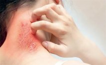 Mantar dəri infeksiyası: simptomlar, müalicə və qarşısının alınması sağlamlıq bələdçisi