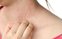 Yazın ən aktiv allergik xəstəliyi