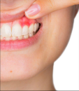 Diş əti iltihabının (gingivitis) müalicəsi