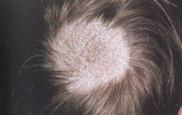 Tinea capitis (saçlı dərinin göbələyi)