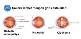 Şəkərli diabet və hipertonik retinopatiyalar