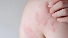 Allergik övrə - övrənin müalicəsi