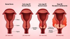 Uterus xərçəngi: səbəbləri, simptomları və müalicəsi