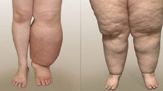 Lipedema xəstəliyi: səbəbləri, müalicəsi və həyat tövsiyələri