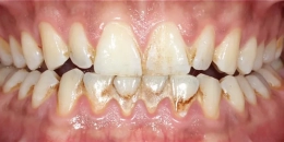 Diş Əti xəstəlikləri: səbəblər, simptomlar və qorunma yolları