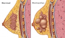 Mastopatiya