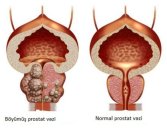 Prostat biopsiyası necə olmalıdır?