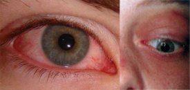 Gözün infeksiyon xəstəliklərinin müalicəsi