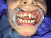 Ağız diş qırıqları və travmaları: