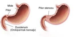 Uşaqlarda pilor stenozu: ilk 3 ayda qusma səbəbləri,mədə çıxışı darlığı