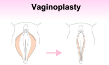 Vaginoplastika