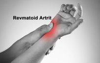 Revmatoid artrit