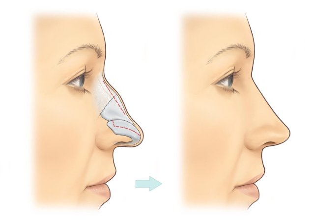 Burun estetikası (rinoplastika): estetik və funksional cərrahi müdaxilə