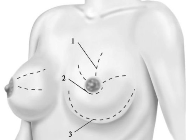 Döş vəzilərinin biopsiyası və patologiyası