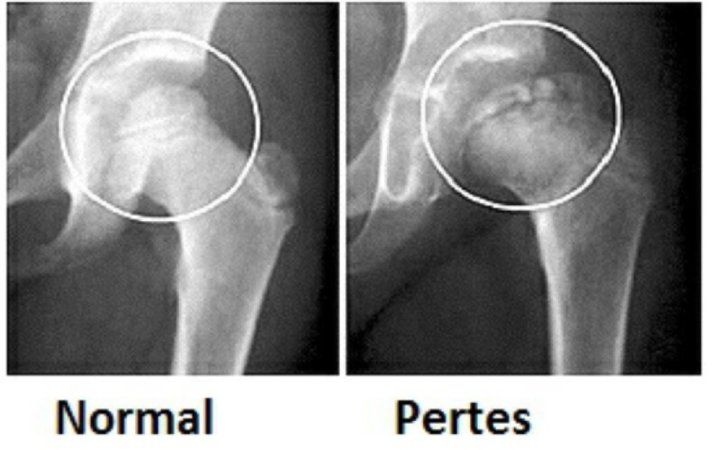 Perthes xəstəliyi haqqında